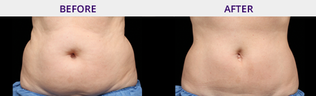 Before and After Picture Coolsculpting